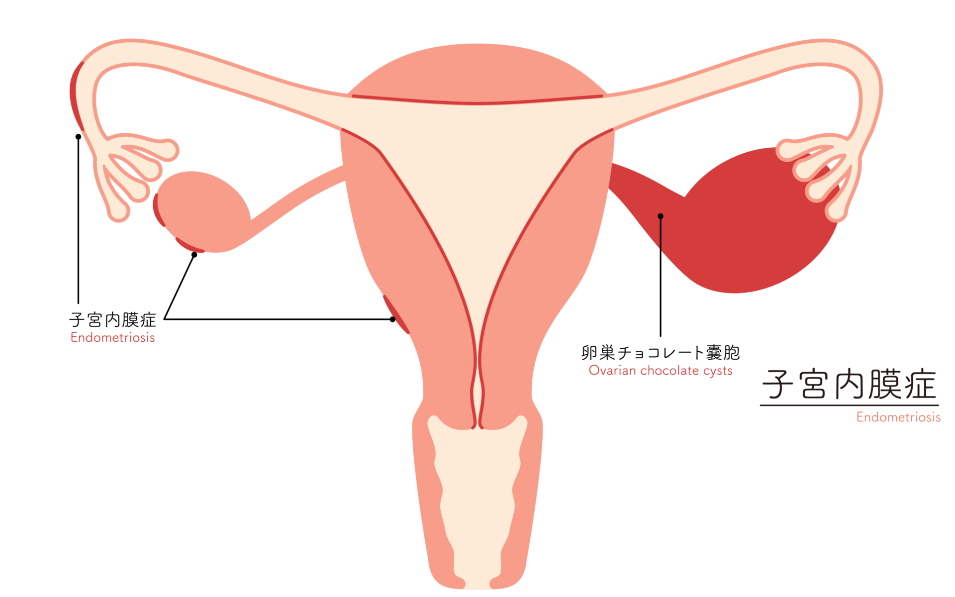 【イラスト】子宮内膜症の図解イラスト